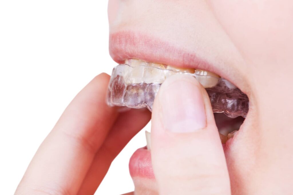 Occlusal Adjustment vs. Night Guard: Which Do You Need? 2 Occlusal Adjustment vs. Night Guard: Which Do You Need?