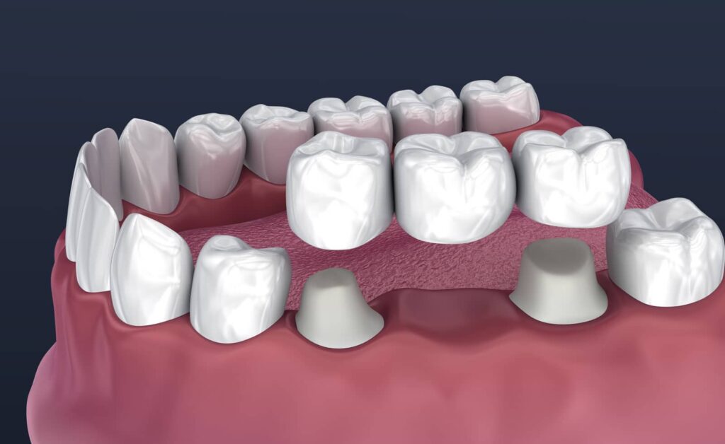 Ceramic Teeth Cap vs Metal Crown: Why More Patients Choose Metal-Free 1 Ceramic Teeth Cap vs Metal Crown: Why More Patients Choose Metal-Free