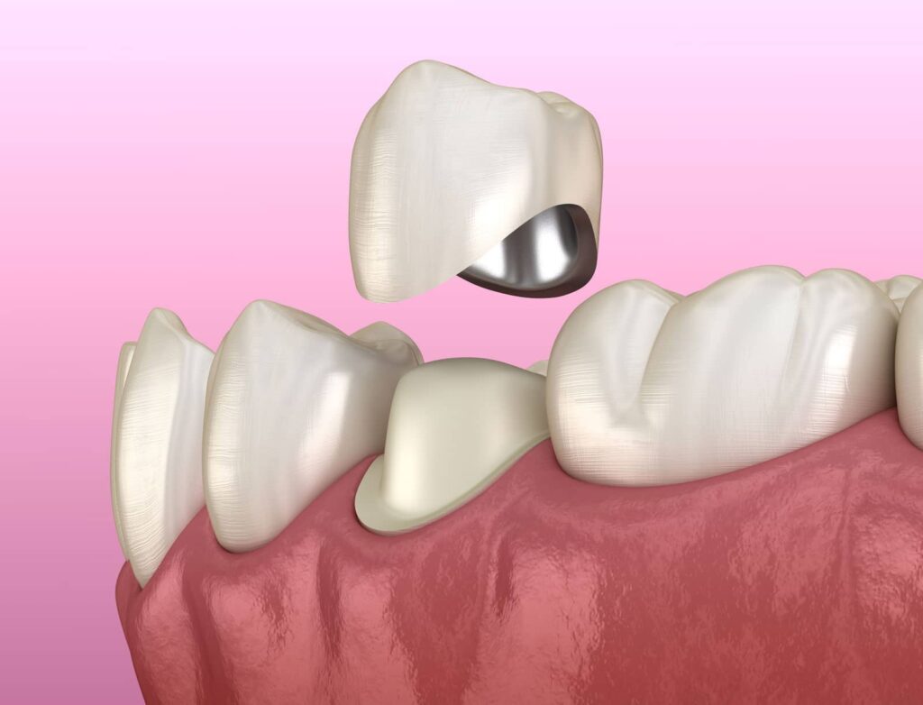 Ceramic Teeth Cap vs Metal Crown: Why More Patients Choose Metal-Free 2 Ceramic Teeth Cap vs Metal Crown: Why More Patients Choose Metal-Free