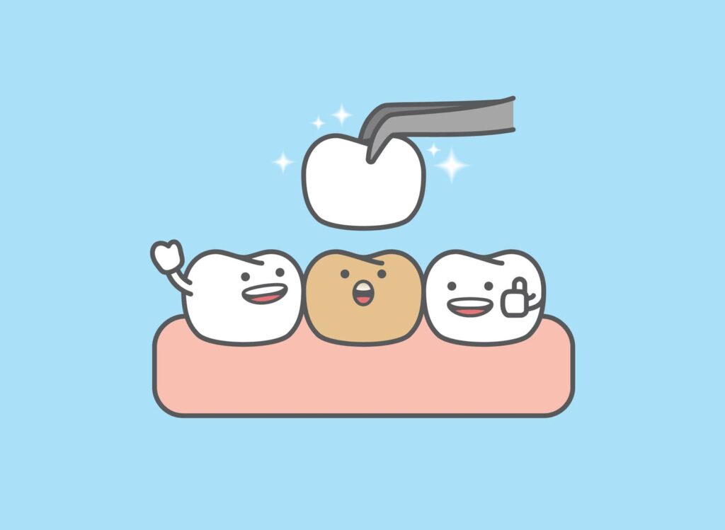 Ceramic Teeth Cap vs Metal Crown: Why More Patients Choose Metal-Free 3 Ceramic Teeth Cap vs Metal Crown: Why More Patients Choose Metal-Free
