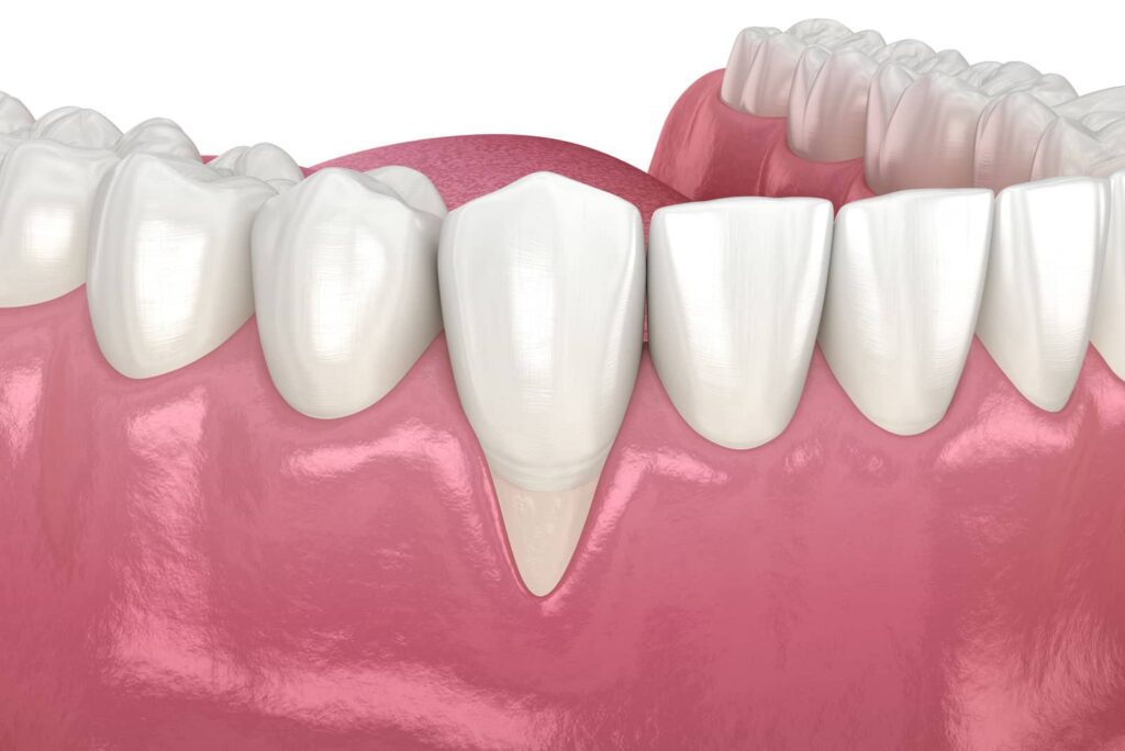 What Is Gingival Recession Surgery? A Plain-Language Guide 1 What Is Gingival Recession Surgery? A Plain-Language Guide
