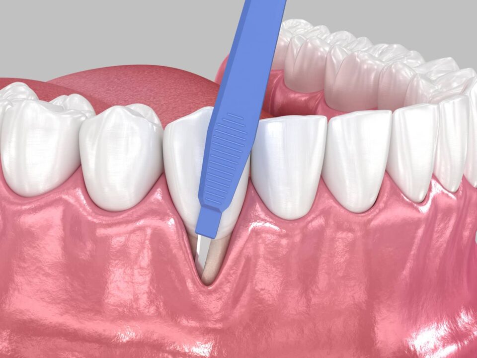 What Is Gingival Recession Surgery? A Plain-Language Guide 6 What Is Gingival Recession Surgery? A Plain-Language Guide