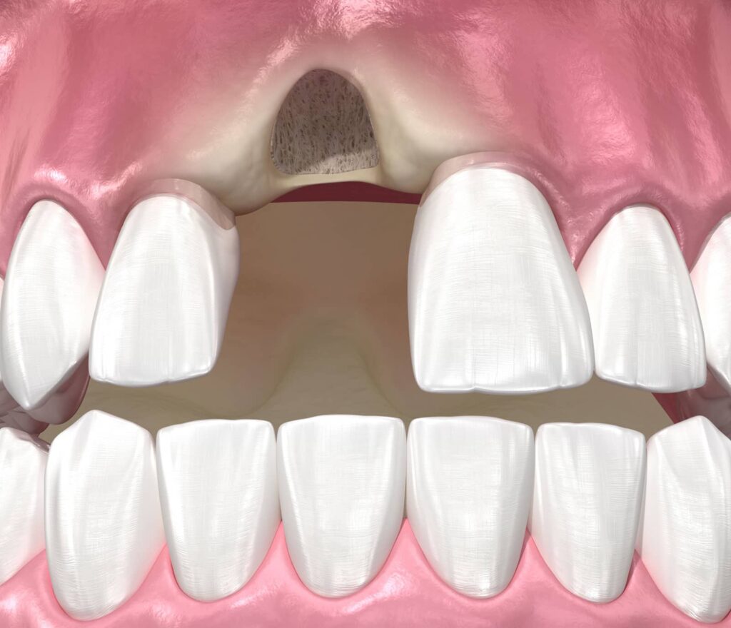 What Is Gingival Recession Surgery? A Plain-Language Guide 3 What Is Gingival Recession Surgery? A Plain-Language Guide